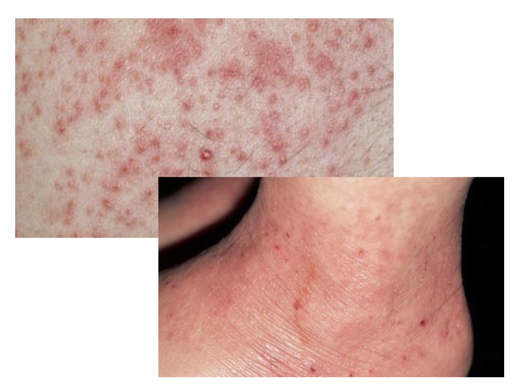 Dry Skin Patches? Demystifying Dermatitis