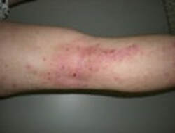 Dry, Itchy Skin Patches? Dermatitis?  So what is dermatitis?  How can we soothe this condition away?